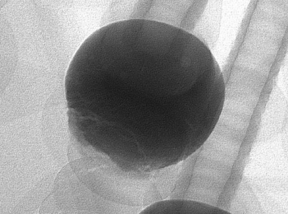 X-RAY high-precision detection of bubble defects in BGA solder joints